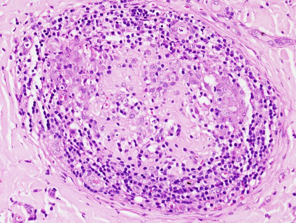 1A6 Leprosy, tuberculoid (Case 1) H&E 5