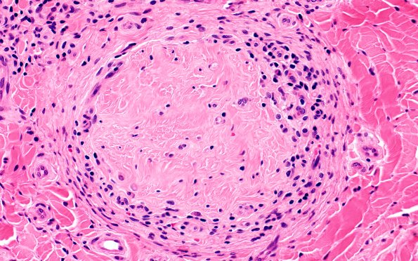 1A7 Leprosy, tuberculoid (Case 1) H&E 40X 3