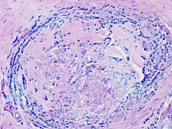 1B1 Leprosy, tuberculoid (Case 1) Fite (negative)