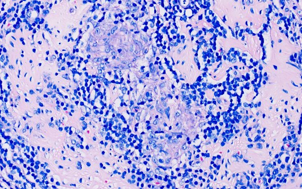 1B2 Leprosy, tuberculoid (Case 1) AFB (negative) 40X