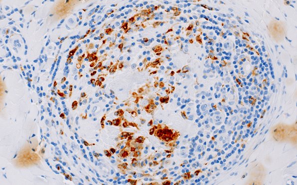 1C2 Leprosy, tuberculoid (Case 1) CD-68 40X