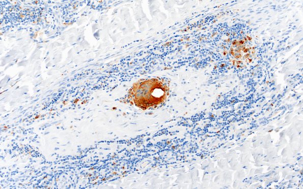 1C3 Leprosy, tuberculoid (Case 1) CD-68 20X 2