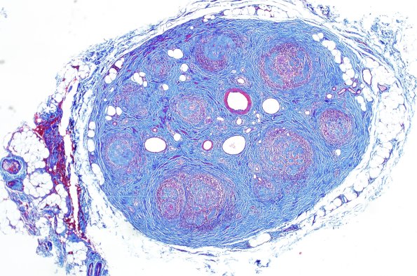 1D1 Leprosy, tuberculoid (Case 1) Trichrome  1