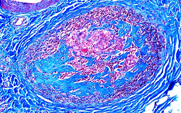 1D2 Leprosy, tuberculoid (Case 1) Trichrome  20X 1