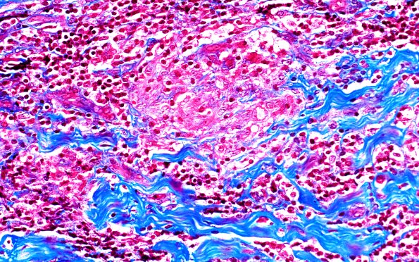 1D3 Leprosy, tuberculoid (Case 1) Trichrome  40X 1