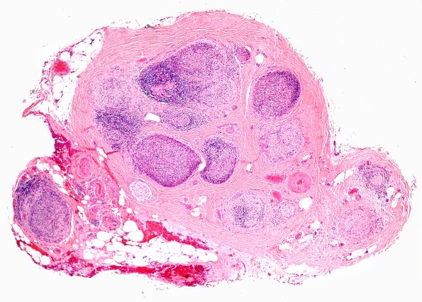 2A1 Leprosy, tuberculoid (Case 2) H&E 4X