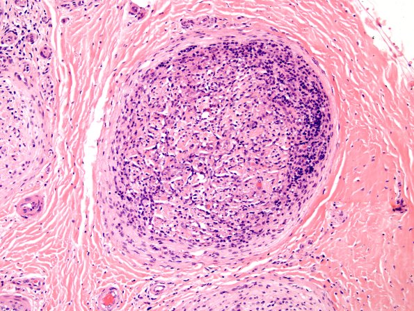 2A3 Leprosy, tuberculoid (Case 2) H&E 2