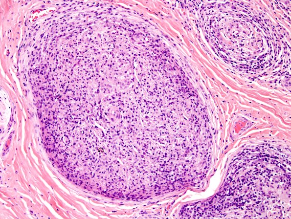 2A5 Leprosy, tuberculoid (Case 2) H&E 5