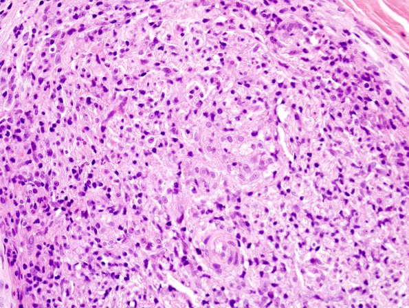 2A6 Leprosy, tuberculoid (Case 2) H&E 4