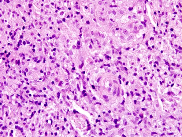 2A7 Leprosy, tuberculoid (Case 2) H&E 1A