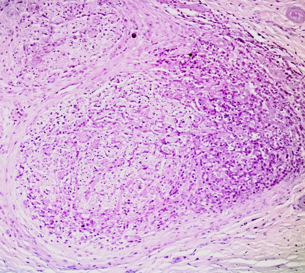 2B1 Leprosy, tuberculoid (Case 2) Fite 6