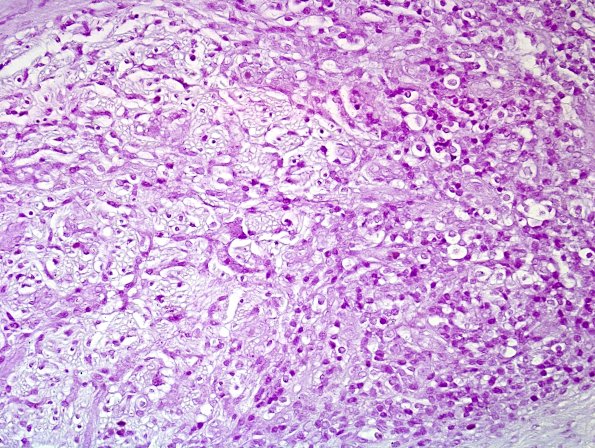 2B2 Leprosy, tuberculoid (Case 2) Fite 7