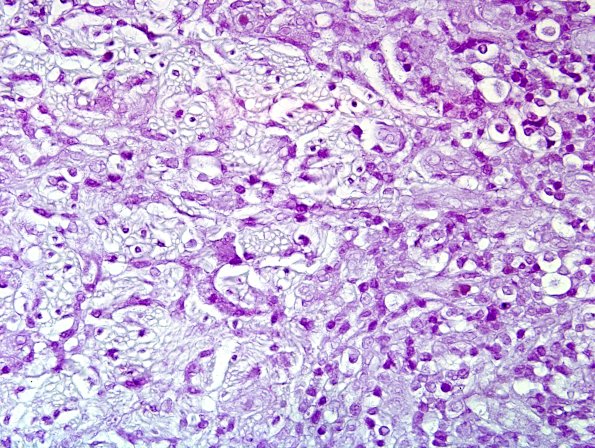 2B3 Leprosy, tuberculoid (Case 2) Fite 8