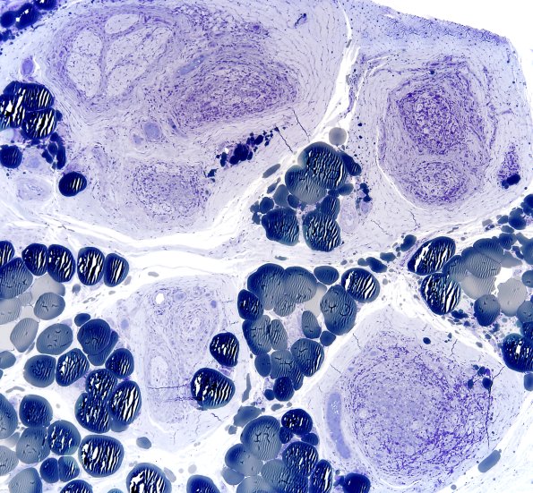 2C1 Leprosy, tuberculoid (Case 2) Plastic 1A