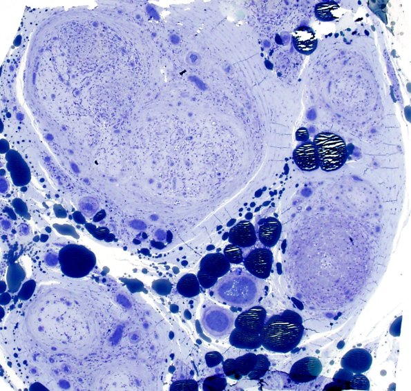 2C2 Leprosy, tuberculoid (Case 2) Plastic 5