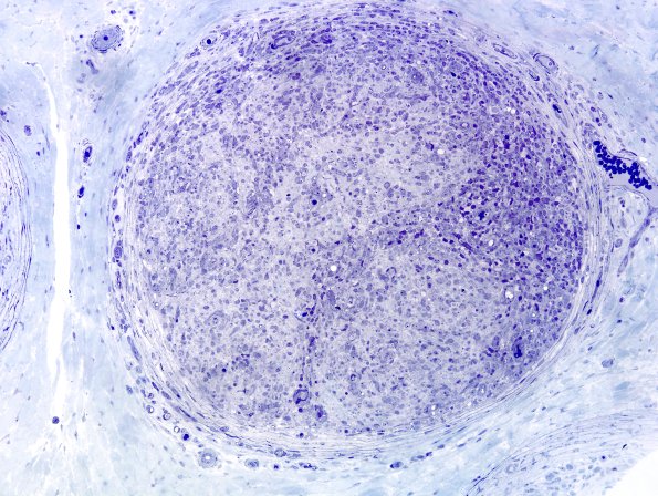 2C3 Leprosy, tuberculoid (Case 2) Plastic 3