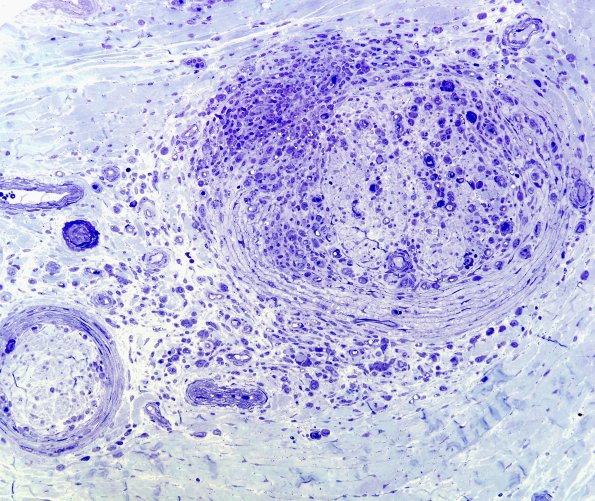 2C6 Leprosy, tuberculoid (Case 2) Plastic 2