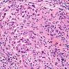 3A10 Leprosy, tuberculoid (Case 3) H&E 3