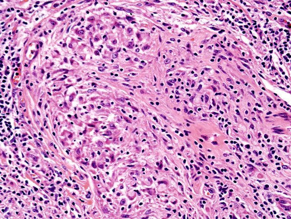 3A10 Leprosy, tuberculoid (Case 3) H&E 3