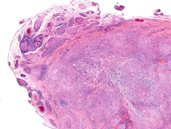 3A2 Leprosy, tuberculoid (Case 3) H&E 4