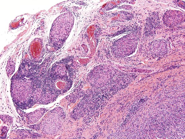 3A3 Leprosy, tuberculoid (Case 3) H&E 6