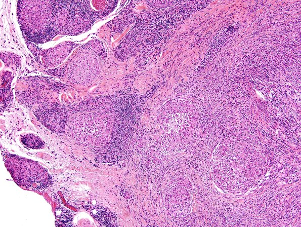 3A4 Leprosy, tuberculoid (Case 3) H&E 5