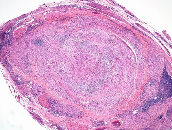 3A5 Leprosy, tuberculoid (Case 3) H&E 1