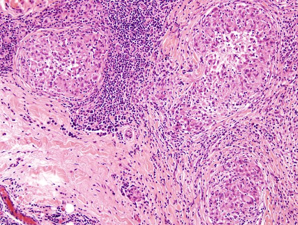 3A6 Leprosy, tuberculoid (Case 3) H&E 7
