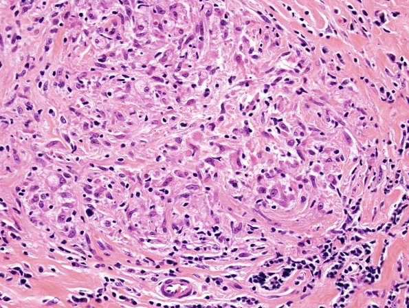 3A9 Leprosy, tuberculoid (Case 3) H&E 9