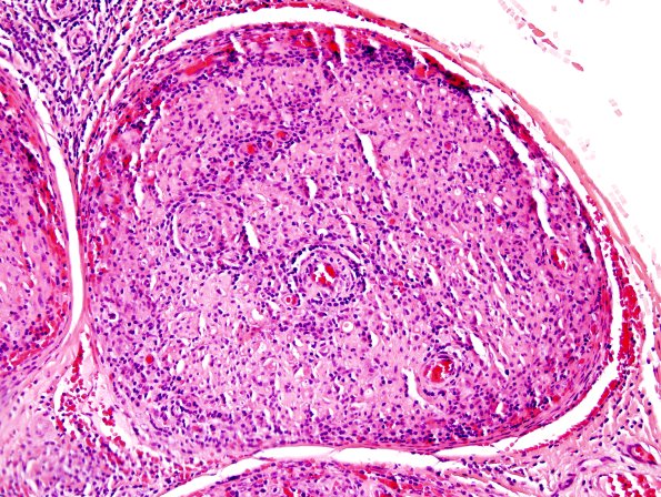 4A2 Leprosy, tuberculoid (AANP 2004-Case 6) H&E 3