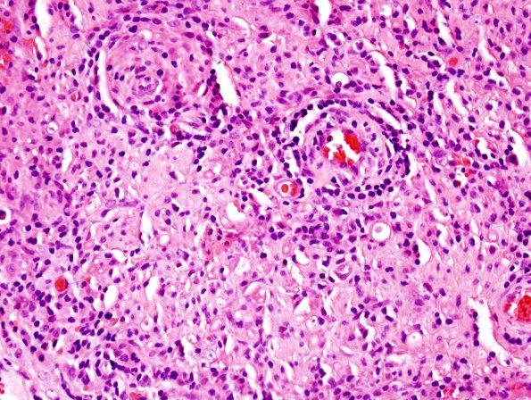 4A3 Leprosy, tuberculoid (AANP 2004-Case 6) H&E 4