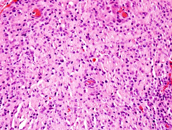 4A4 Leprosy, tuberculoid (AANP 2004-Case 6) H&E 5