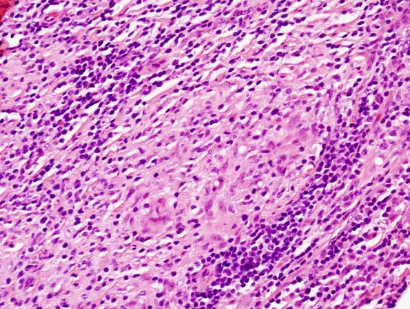 4A5 Leprosy, tuberculoid (AANP 2004-Case 6) H&E 6
