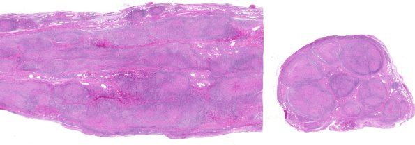 5A1 Leprosy, Tuberculoid (Case 5) 2C
