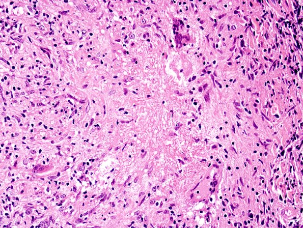 5A10 Leprosy, tuberculoid (Case 5) H&E 9