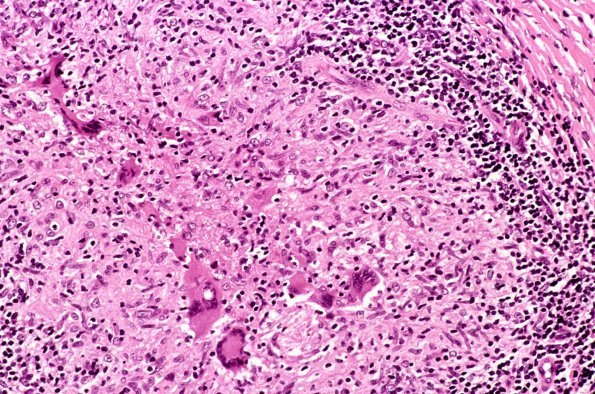 5A12 Case 5 leprosy14A