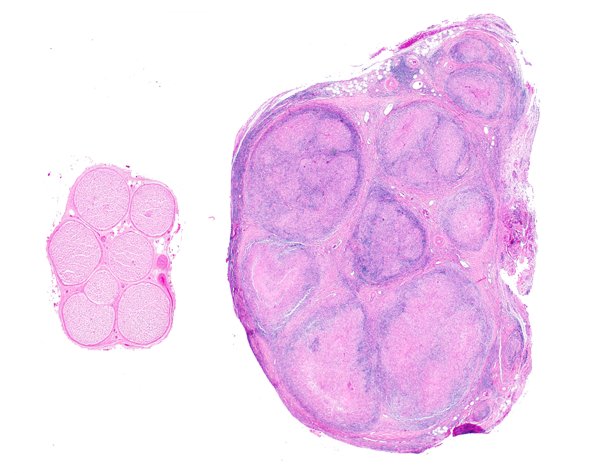 5A2 Case 5 Normal vs tuberculoid leprosy