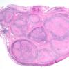 5A3-Leprosy-tuberculoid-Case-5-H-E-2x-1.jpg