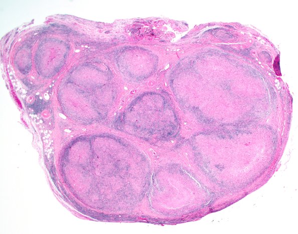 5A3-Leprosy-tuberculoid-Case-5-H-E-2x-1.jpg