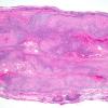 5A4-Leprosy-tuberculoid-Case-5-H-E-2x-3.jpg