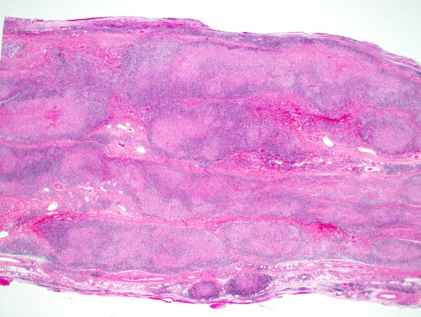 5A4-Leprosy-tuberculoid-Case-5-H-E-2x-3.jpg
