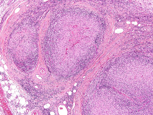 5A5 Leprosy, tuberculoid (Case 5) H&E 3