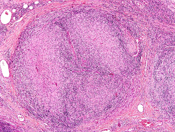 5A6 Leprosy, tuberculoid (Case 5) H&E 5