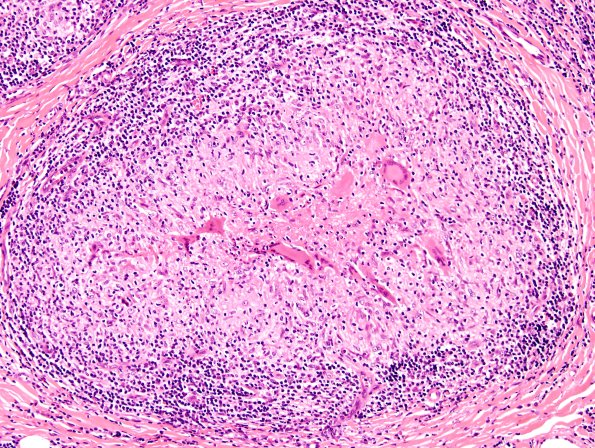 5A7 Leprosy, tuberculoid (Case 5) H&E 7