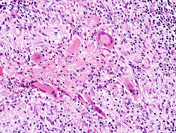 5A8 Leprosy, tuberculoid (Case 5) H&E 8
