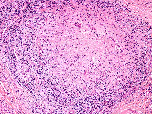 5A9 Leprosy, tuberculoid (Case 5) H&E 6