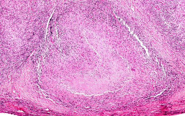 5B1 Leprosy, Tuberculoid (Case 5) 10X A