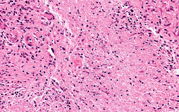 5B2 Leprosy, Tuberculoid (Case 5) 40X