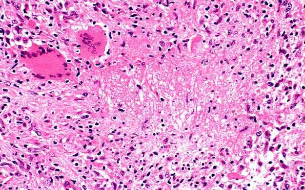 5B3 Leprosy, Tuberculoid (Case 5) 40X 2