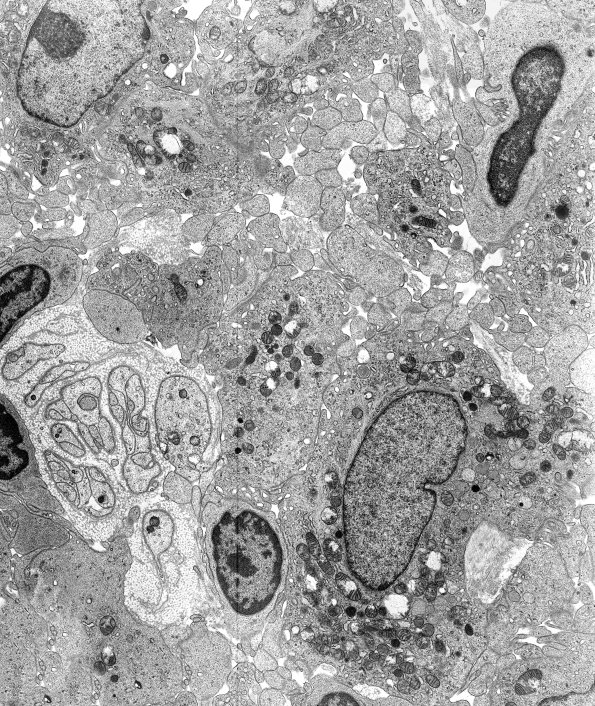5C Case 5 Tuberculoid leprosy EM A - Copy
